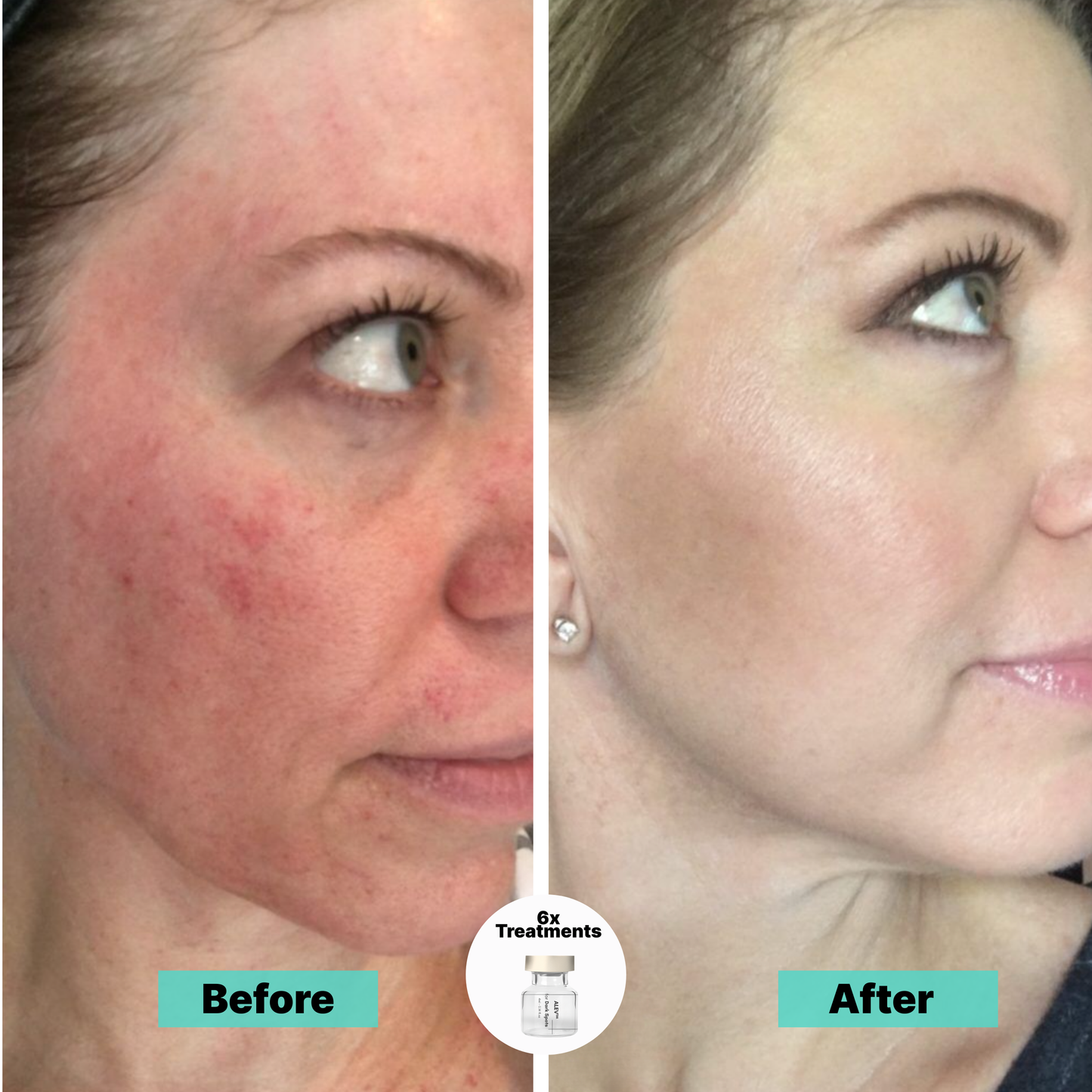 Fade dark spots and smooth wrinkles with the Micro-Infusion Facial System