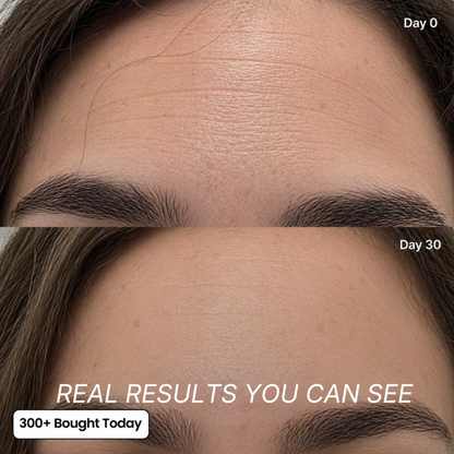 The Ozempic Face Fix — Restore Lost Facial Volume Without Needles