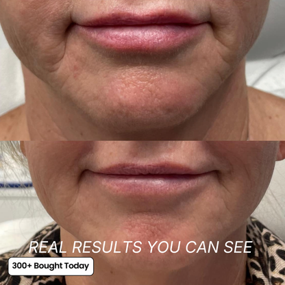 The Ozempic Face Fix — Restore Lost Facial Volume Without Needles
