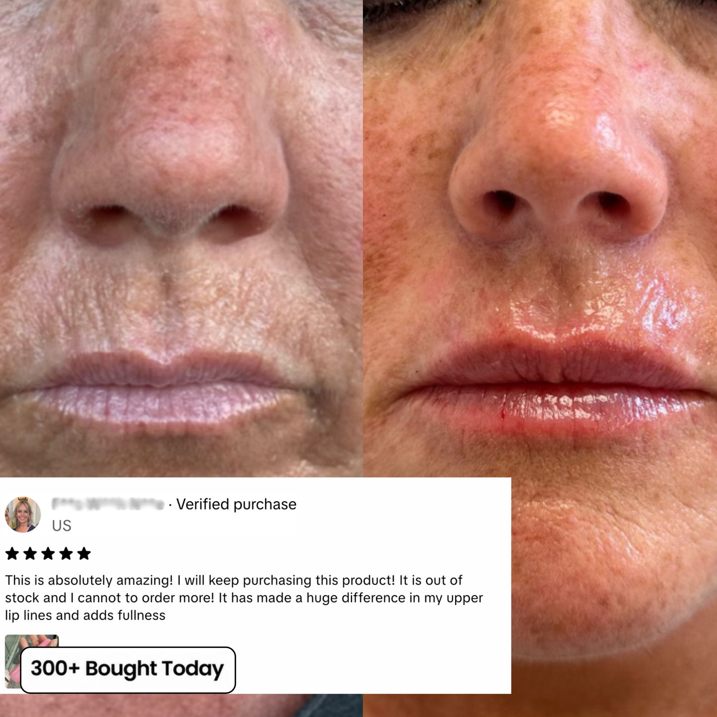 The Ozempic Face Fix — Restore Lost Facial Volume Without Needles