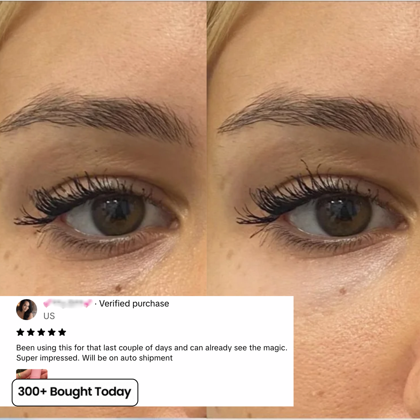 The Ozempic Face Fix — Restore Lost Facial Volume Without Needles
