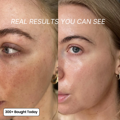 The Ozempic Face Fix — Restore Lost Facial Volume Without Needles